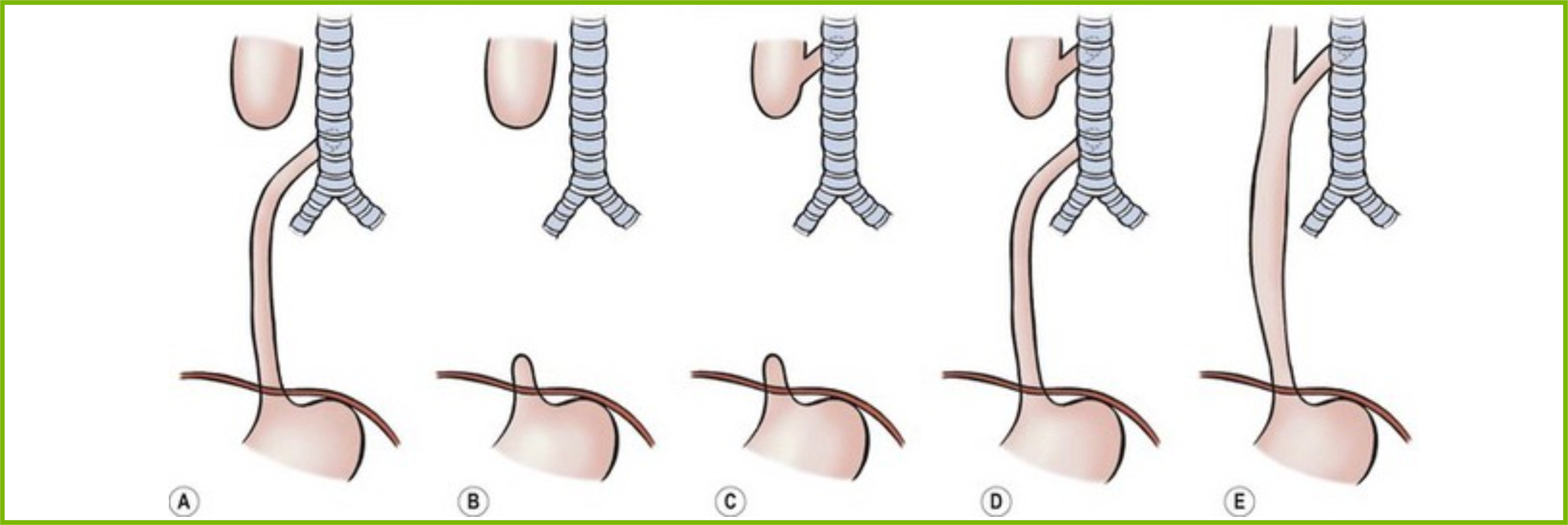 Слепой пищевод. Трахеопищеводный свищ. Врожденный пищеводно-трахеальный свищ это. Врожденный трахеопищеводный свищ. Атрезия пищевода классификация.